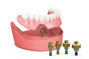 インプラント義歯