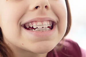 乳歯列期治療(検査料不要)